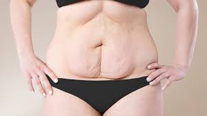 Loose Skin