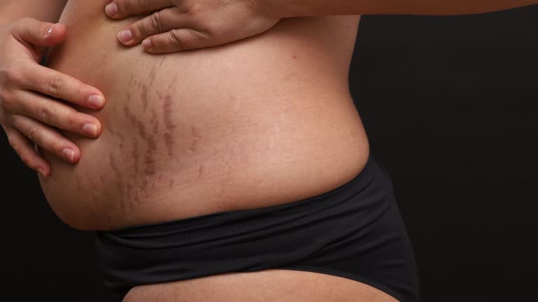 Stretch Marks
