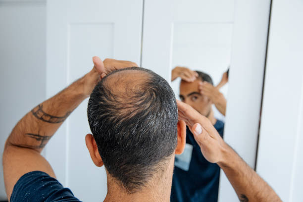Balding